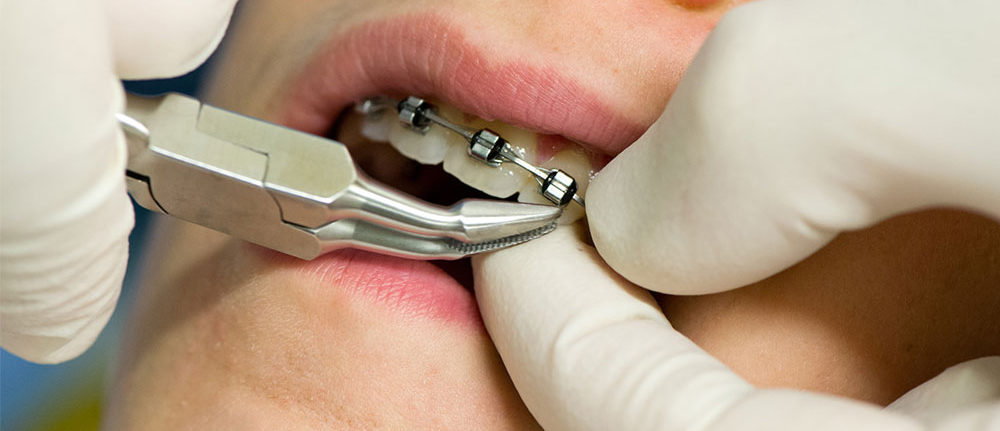 Ortodonzia-fissa Apparecchio denti per adulti e bambini a Padova: fai tornare loro il sorriso - Studio ortodontico