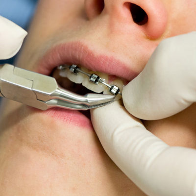 Apparecchio denti per adulti e bambini a Padova: fai tornare loro il sorriso - Studio ortodontico