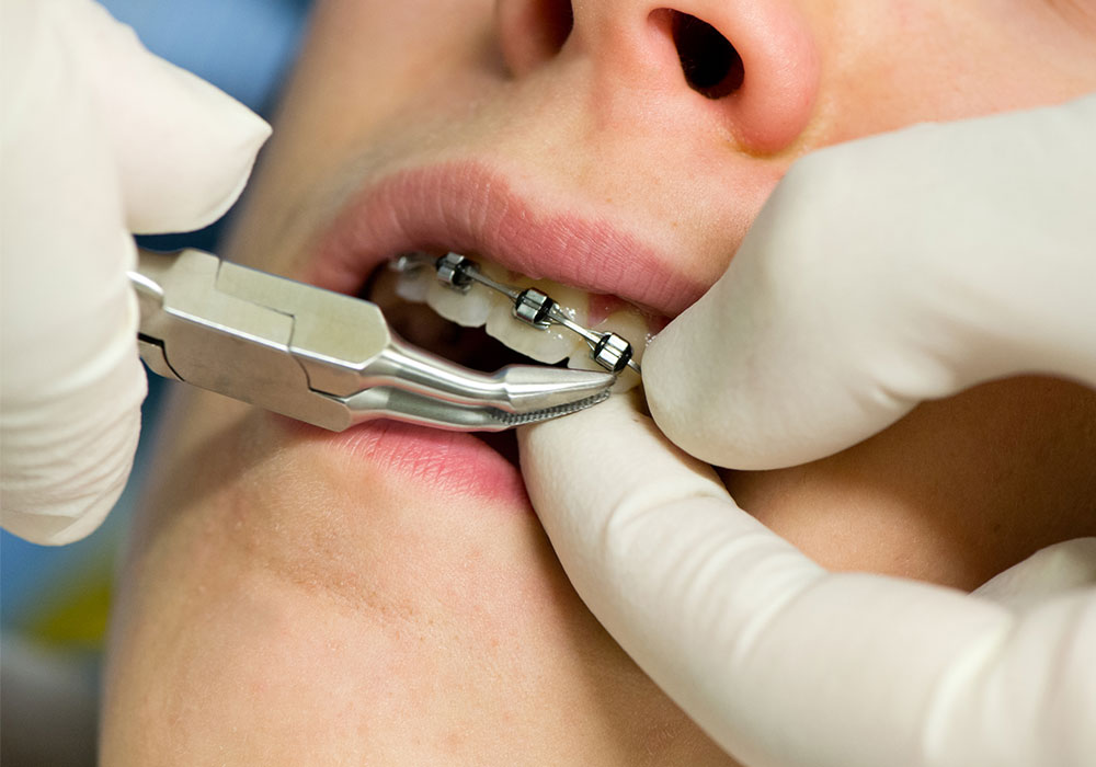 Apparecchio denti per adulti e bambini a Padova: fai tornare loro il sorriso - Studio ortodontico