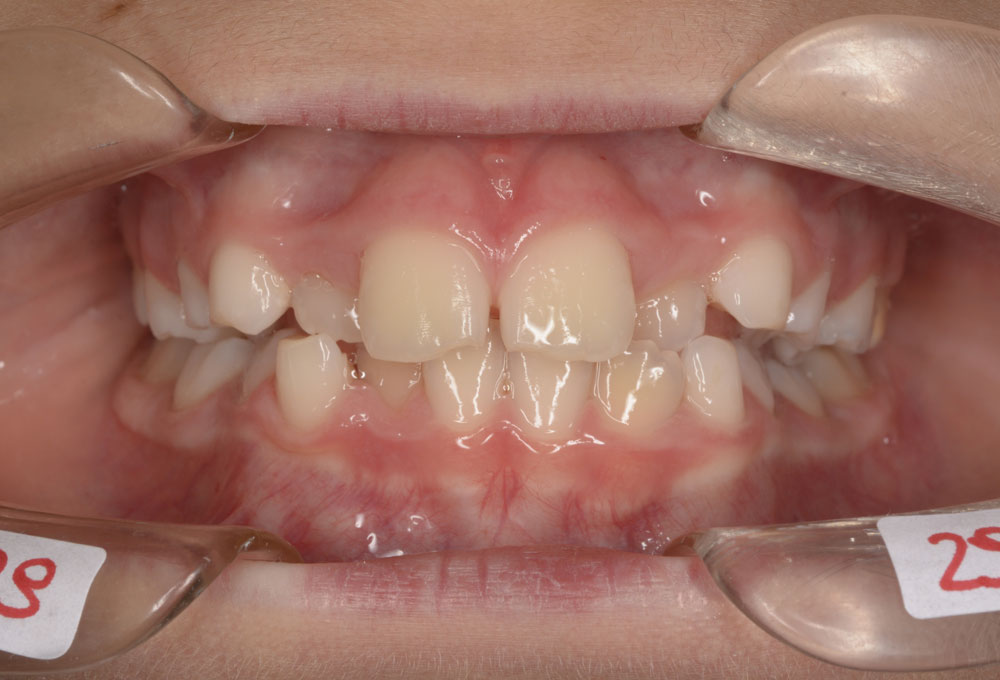 Palato stretto post-trattamento