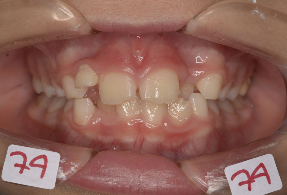 Palato stretto pre-trattamento