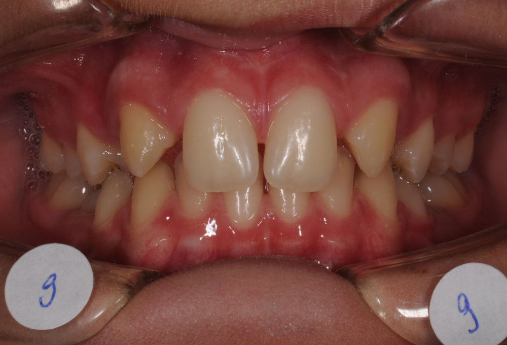 Trattamenti ortodontici adolescente - Agenesie dentarie - Pre trattamento - CENTRO ORTODONZIA BAVARESCO